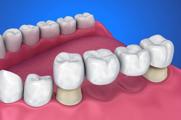 Dental Implant4
